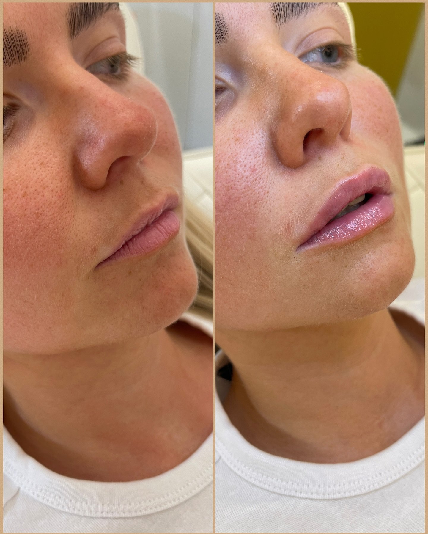 First time lips 👄 

#lips #lipfiller #aesthetics #tgif #fyp #injectables #injections #kiss #lisburn