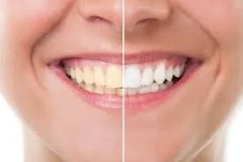 teeth+whitening.jpg