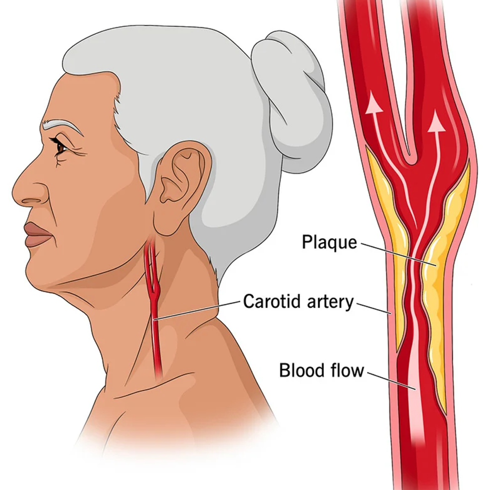 Carotid Artery Disease Treatment Dallas Advantage Vascular carotid-artery-disease-treatment-dallas-advantage-vascular