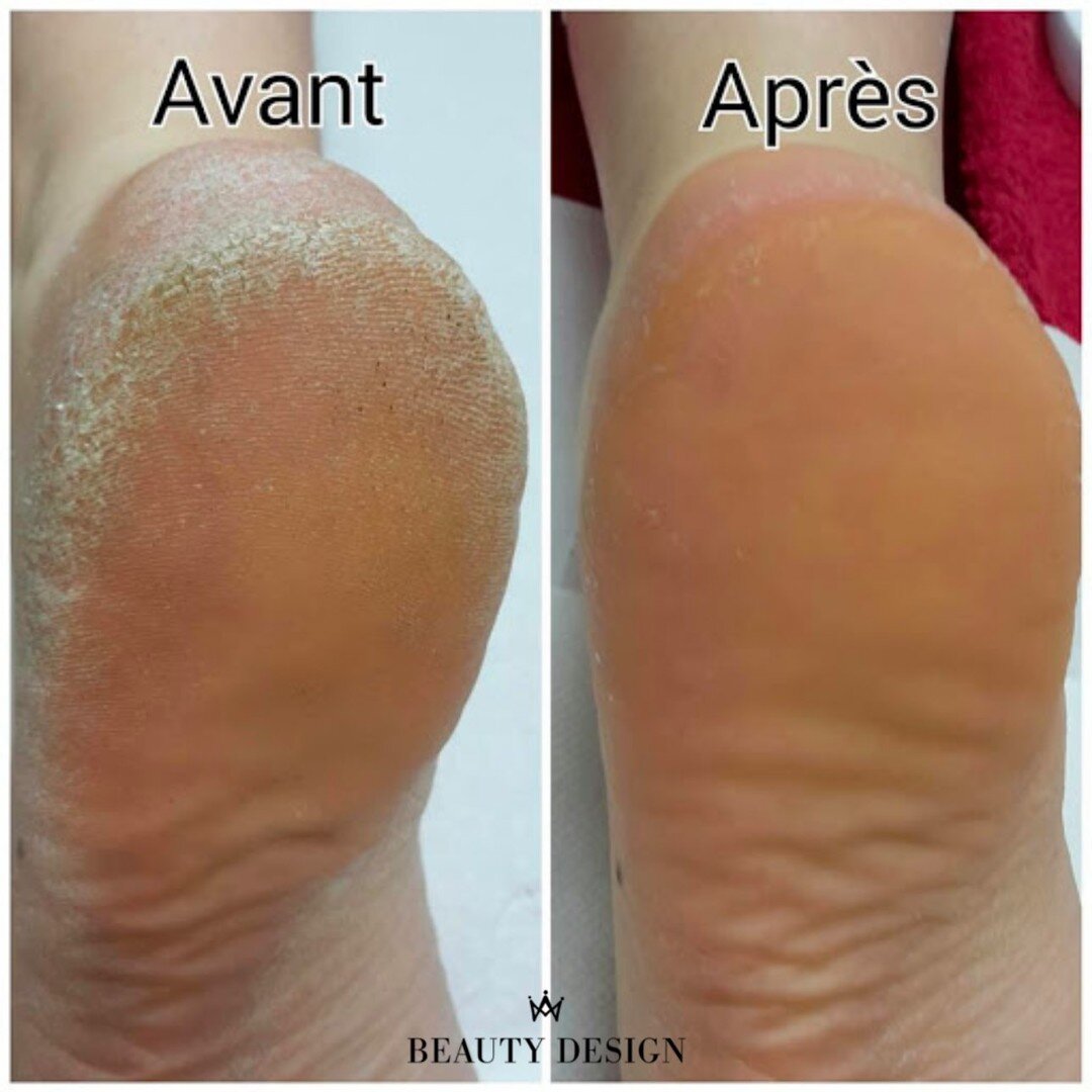 Pr&eacute;parez vos pieds pour l&rsquo;&eacute;t&eacute; avec Beautydesign !😊 ☀️

Copi&eacute; mais jamais &eacute;gal&eacute;, Calluspeeling&reg;️ est sp&eacute;cialis&eacute; dans le traitement professionnel pour la beaut&eacute; des pieds. 🌸

Pr