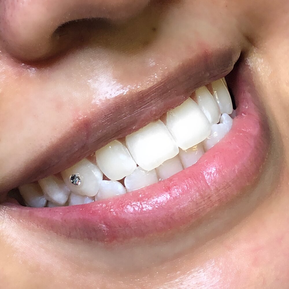 Tooth Gems in Surrey, Tooth Charms