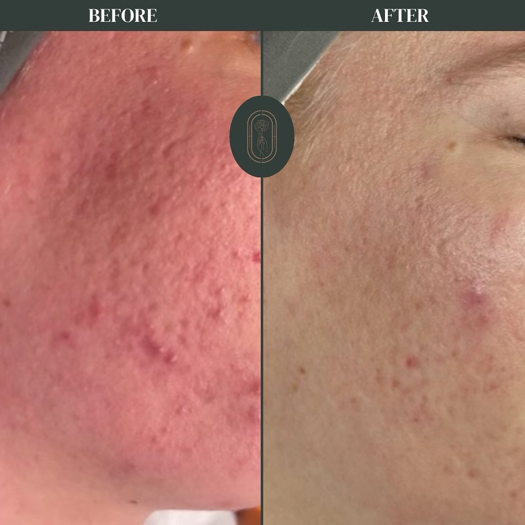 It&rsquo;s our first and most important goal to get you comfortable in your skin! Redness and barrier issues are a sign that the skin is in desperate need of repair and comfort. You can&rsquo;t heal acne without first healing the skin&rsquo;s barrier
