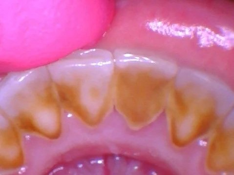 Before: 20 years since last cleaning