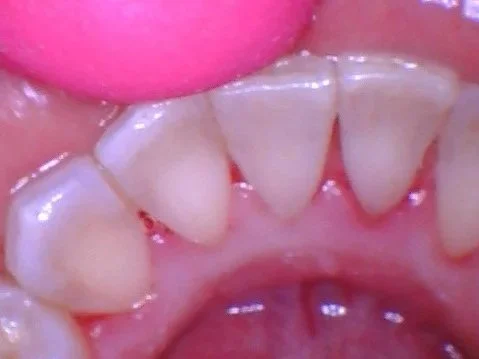 After: Deep Cleaning Performed