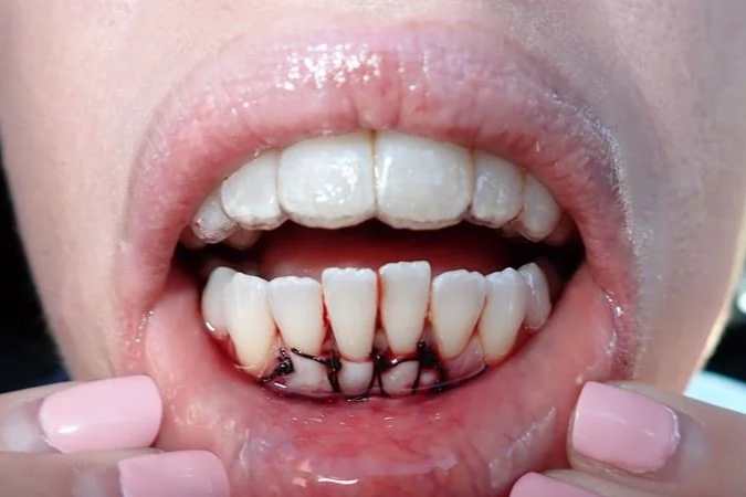 Free gingival graft immediately post-op