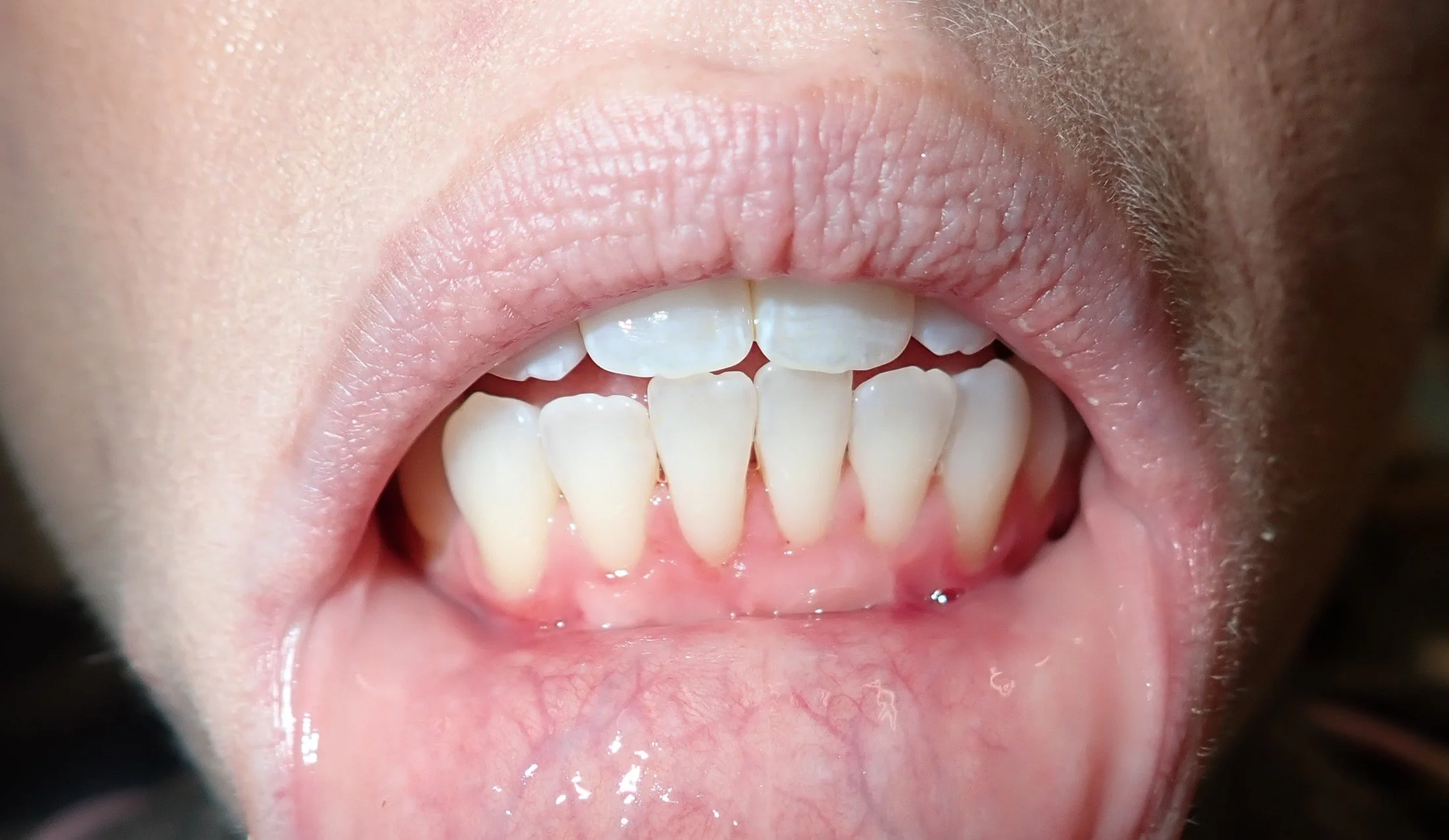 Free gingival graft 8 weeks post-op