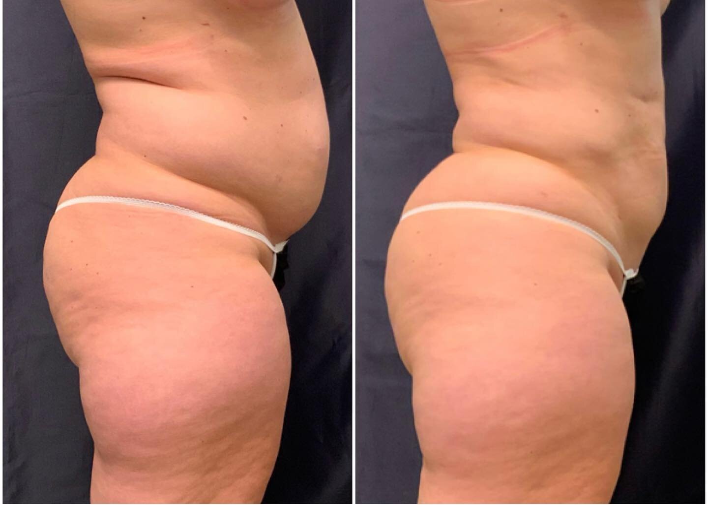 Check out these before and afters! 

This patient underwent a  laser lipo procedure that drastically reduced inches around her waist and abdomen while also tightening the skin. These pictures were taken only 6 weeks apart! 

Interested in learning mo