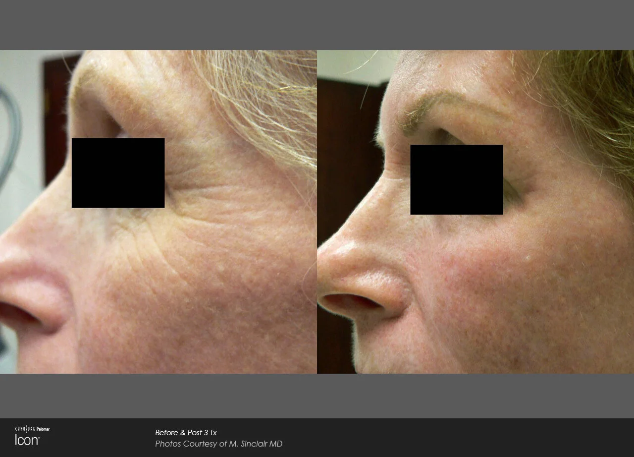 Skin-Renewal-Before-&-After-Photo-2.jpg