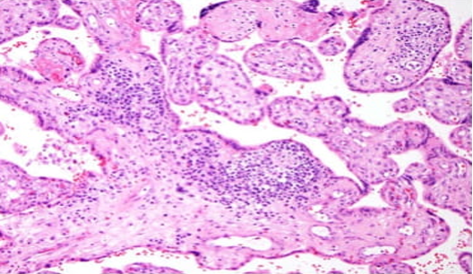 Abnormal Immune Placentation — Sydney Reproductive Immunology - A ...