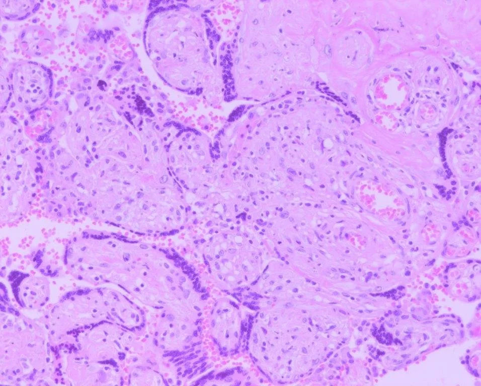 Abnormal Placentation — Sydney Reproductive Immunology - A/Professor ...