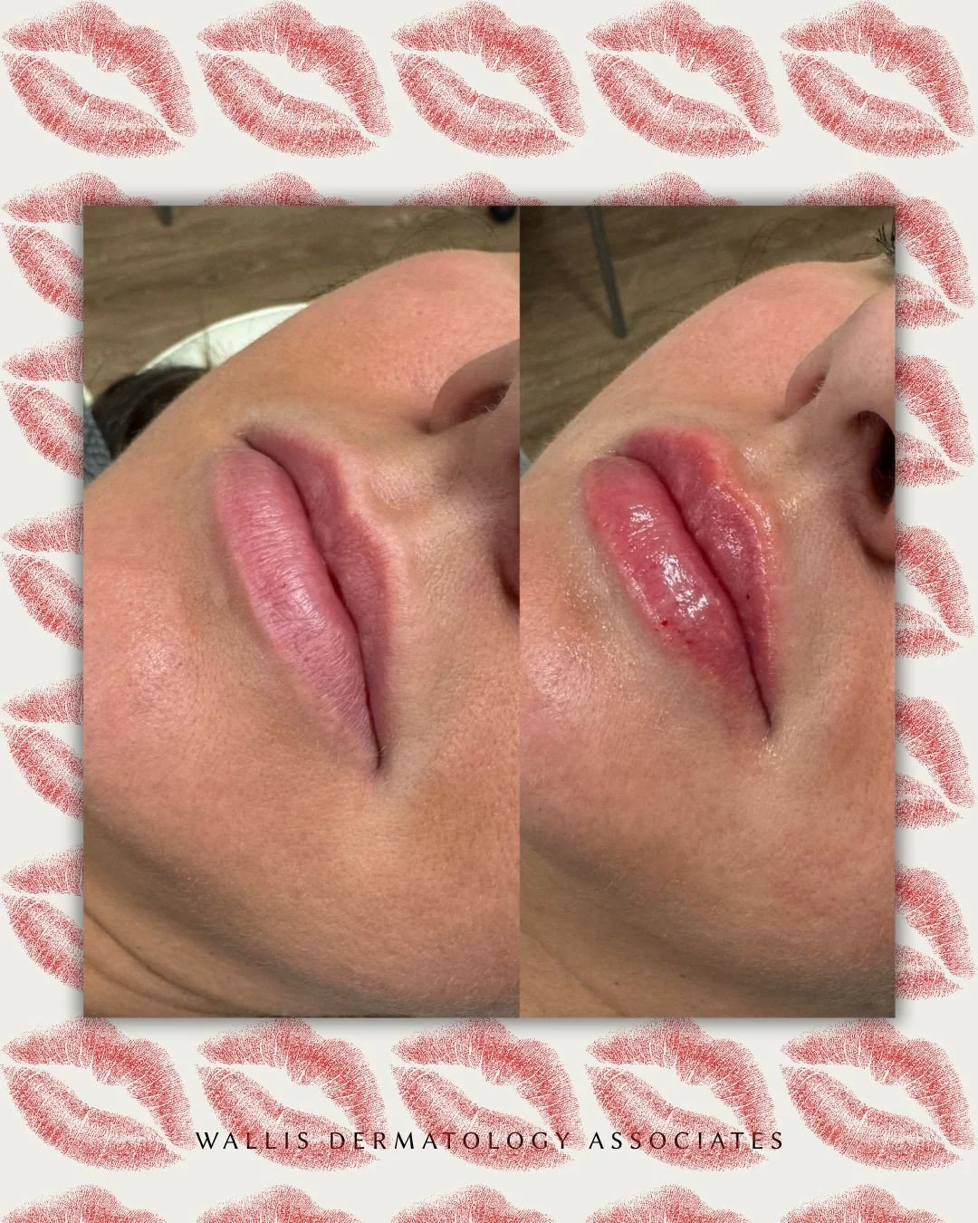 Soft, balanced, and natural-looking 💋⁠
⁠
Lip filler is all about enhancing what you already have &mdash; restoring volume, improving symmetry, and creating subtle definition while keeping results true to you.⁠
⁠
At Wallis Dermatology Associates, our