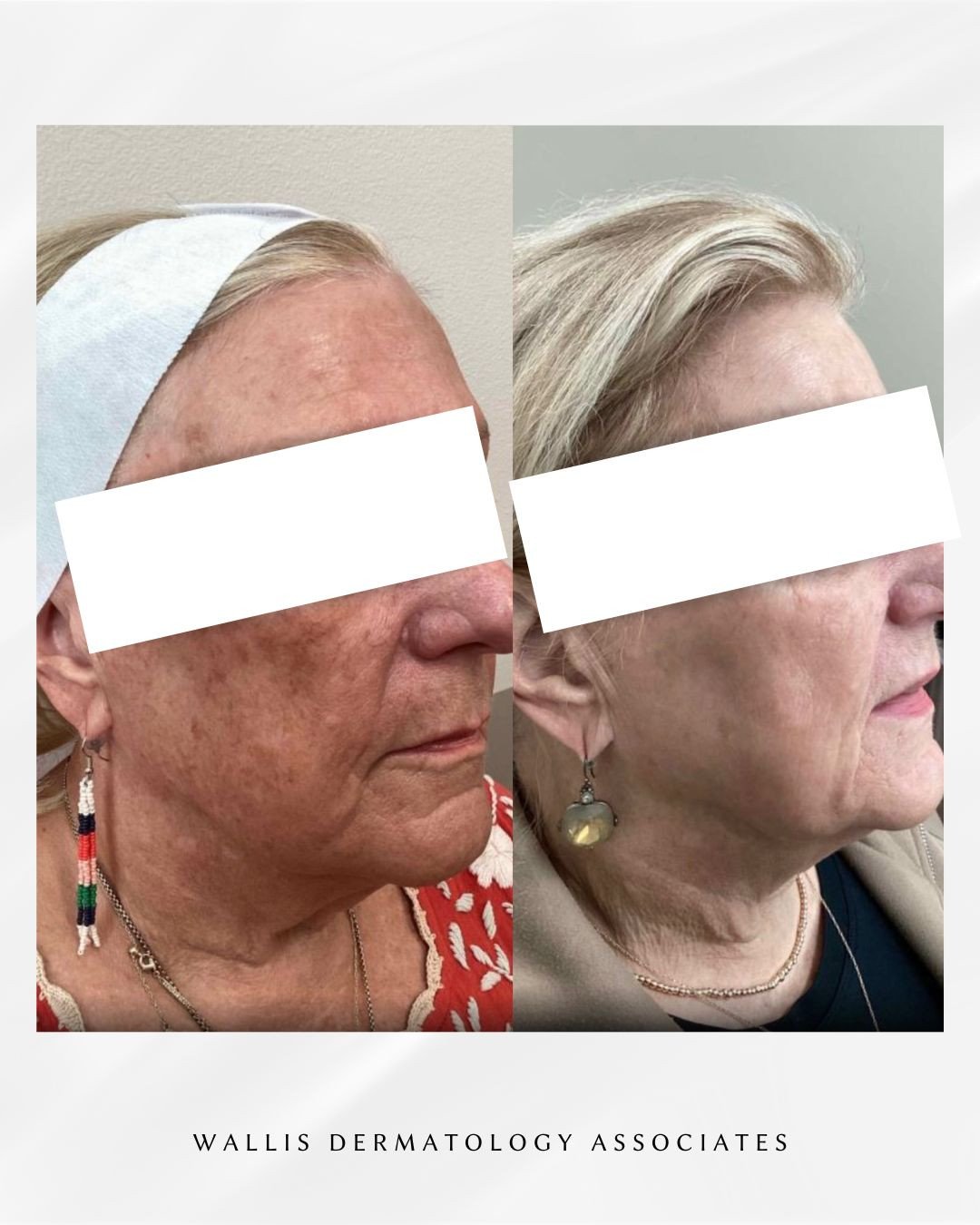 Real results. Real confidence ✨⁠
⁠
This before-and-after highlights the power of a BioRePeel series paired with one IPL treatment &mdash; a combination designed to improve skin tone, texture, and overall clarity.⁠
⁠
BioRePeel helps refresh and stimul