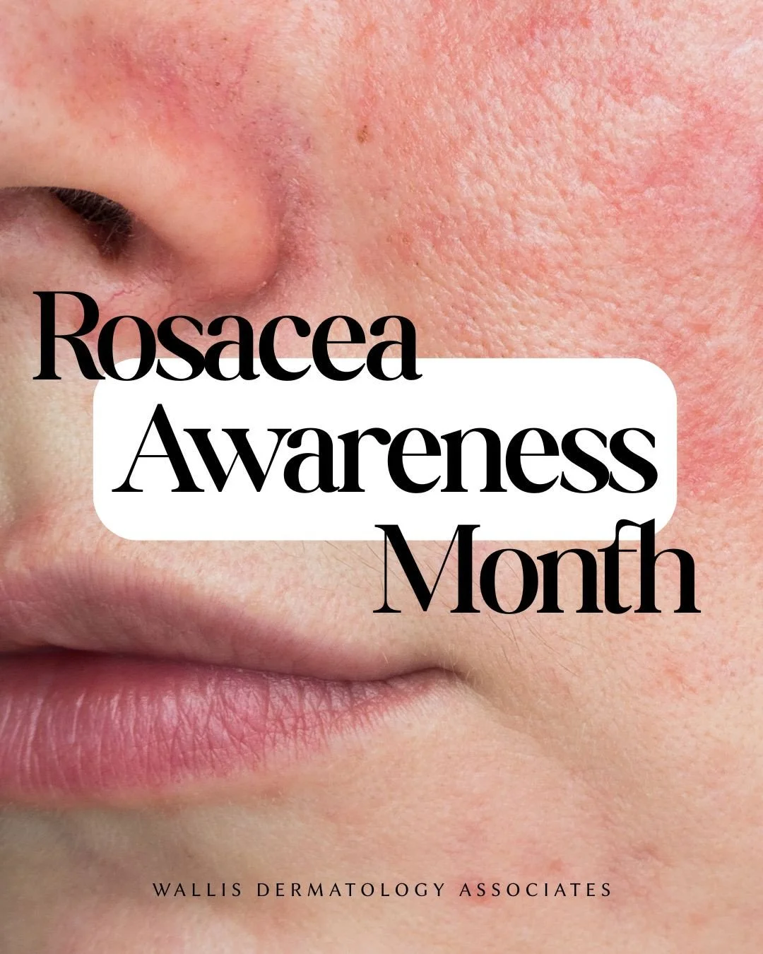 April is Rosacea Awareness Month&mdash;a time to shed light on a condition that affects millions, yet is often misunderstood.⁠
⁠
Rosacea isn&rsquo;t just occasional redness. It can present as persistent flushing, visible blood vessels, acne-like brea