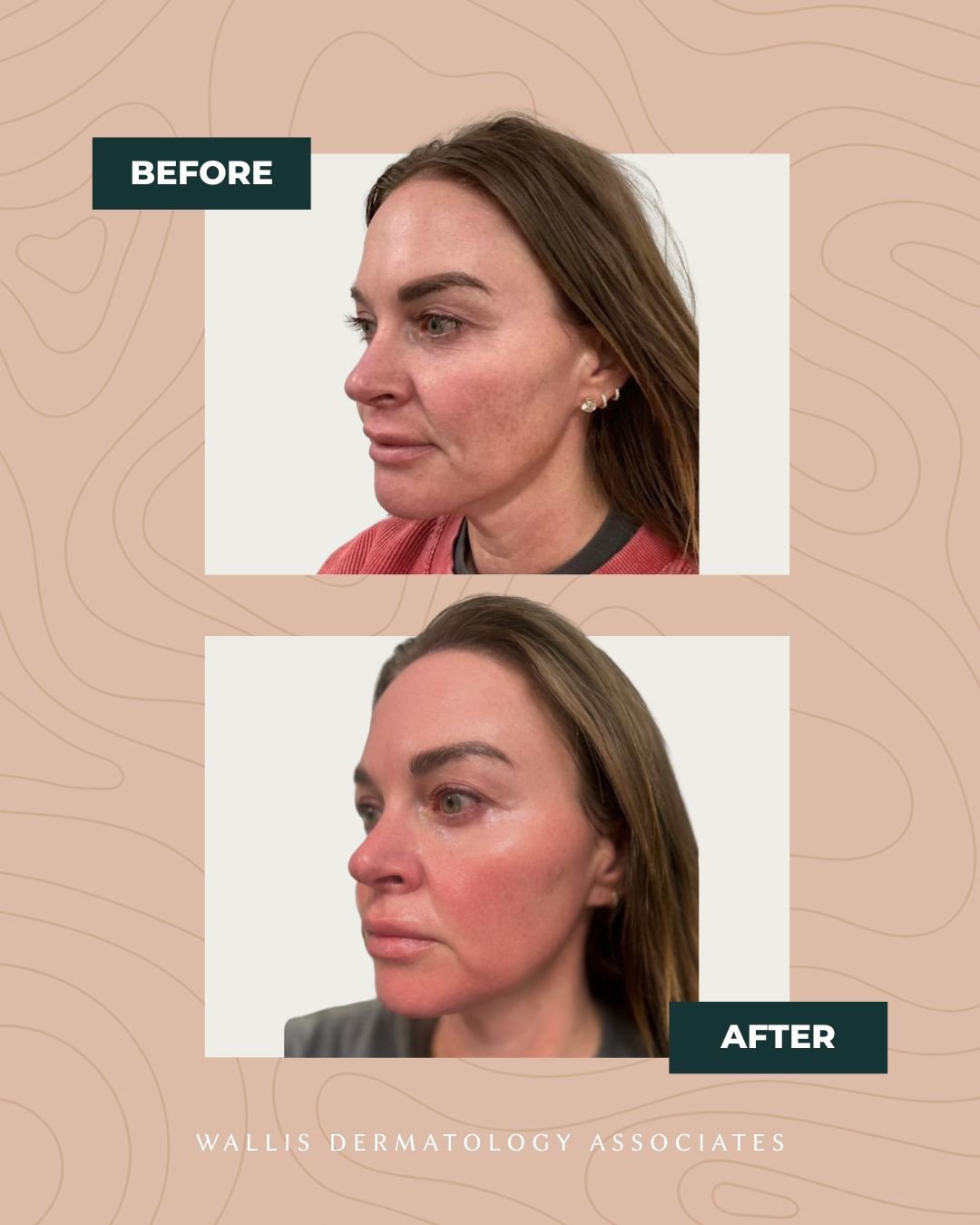 ✨ The Moxi Glow ✨⁠
⁠
We love this treatment for its ability to "reset" the skin with minimal downtime. For this patient, we targeted sun damage and uneven texture to reveal a brighter, more refined complexion.⁠
⁠
It&rsquo;s the perfect &quo