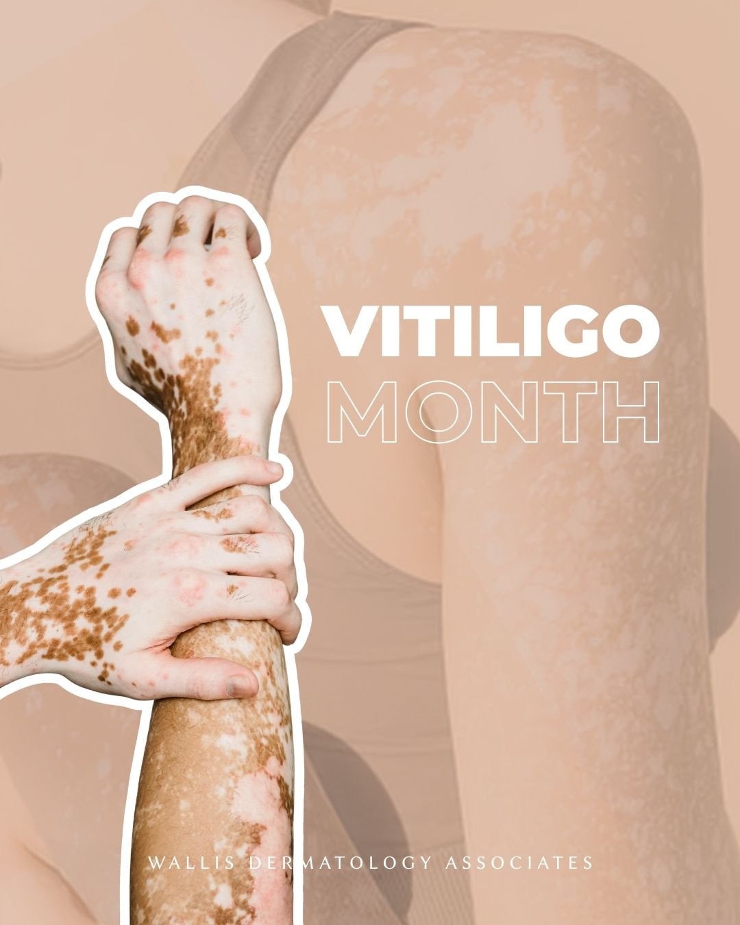 June is Vitiligo Awareness Month.⁠
⁠
Vitiligo occurs when pigment-producing cells stop functioning, but it doesn&rsquo;t change who you are. We offer the latest medical treatments and light therapies to help you manage your skin health and feel confi