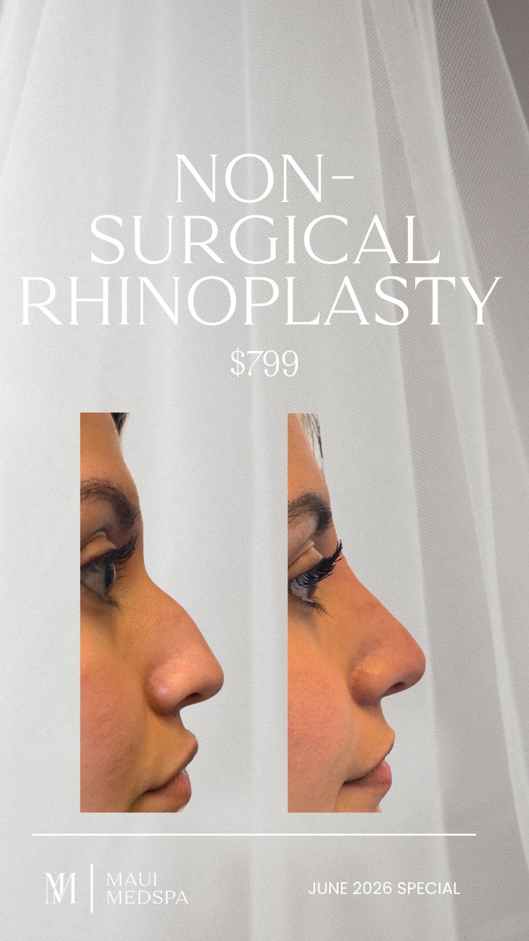Non Surgical Rhinoplasty