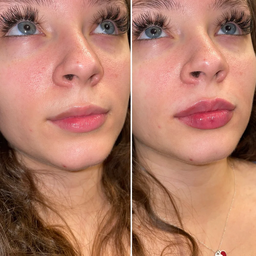 Best Lip Fillers in Austin, TX - Lip Augmentation | Maui MedSpa