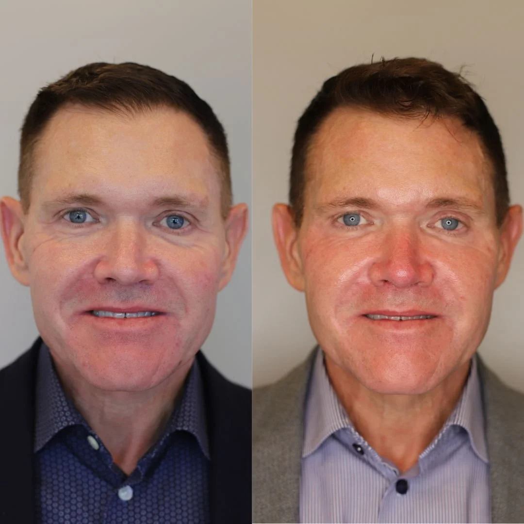 Before and after results of a man 6 months after 4 vials of Sculptra.