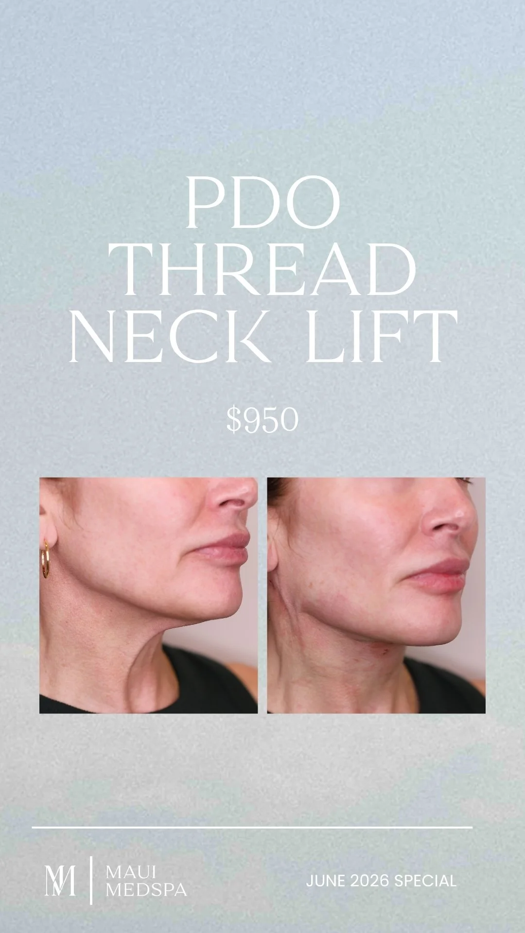 PDO Thread NeckLift