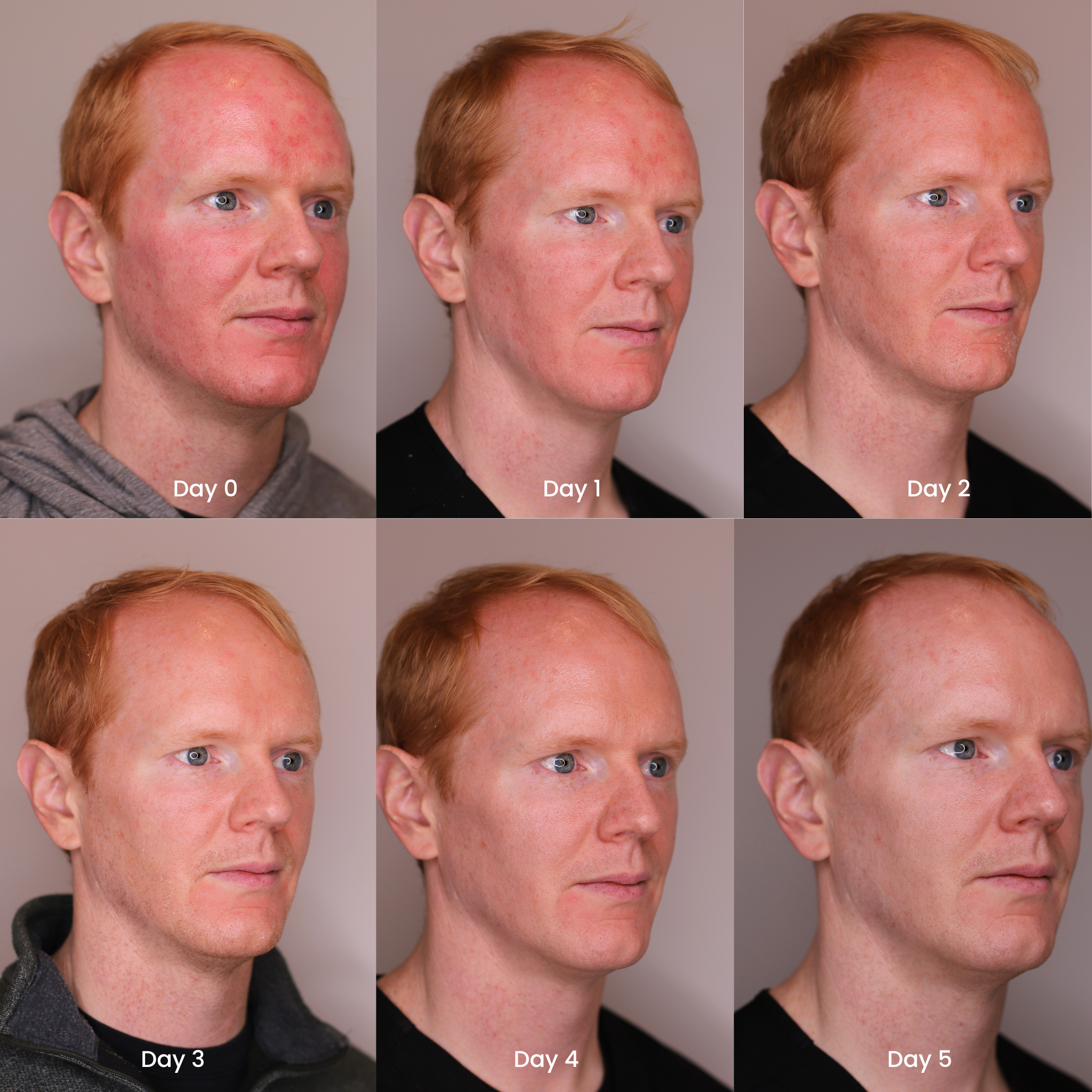 5 day healing timeline for microneedling