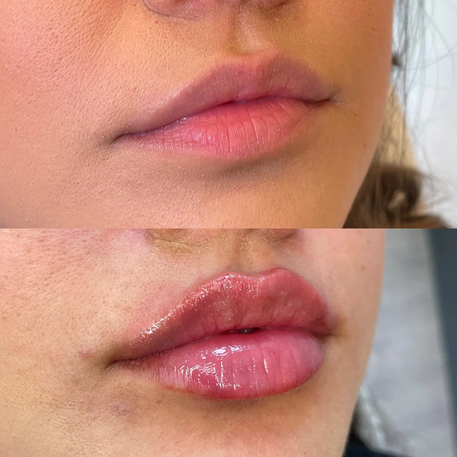 Best Lip Fillers in Austin, TX Lip Augmentation Maui MedSpa