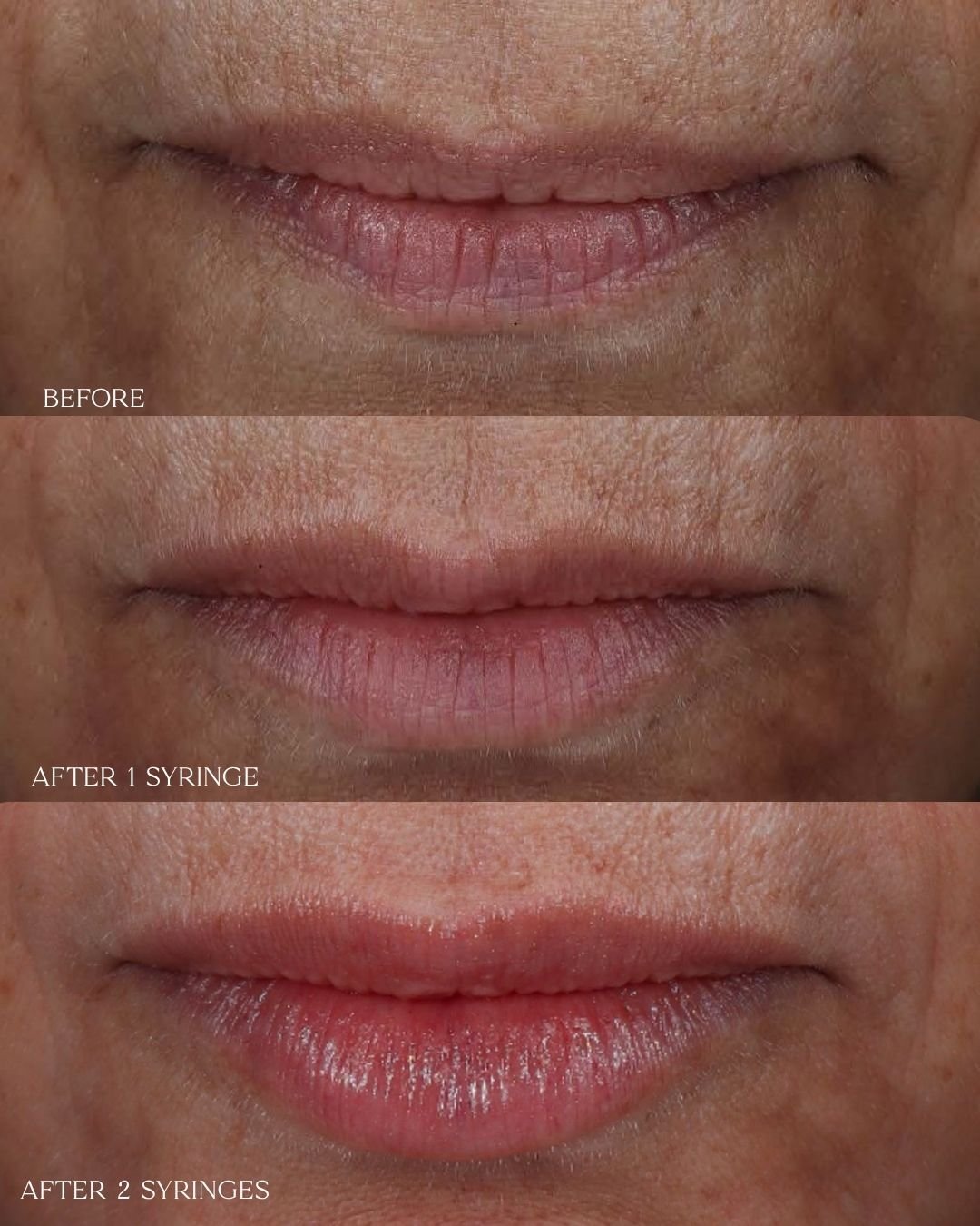 Lip Filler Stacking