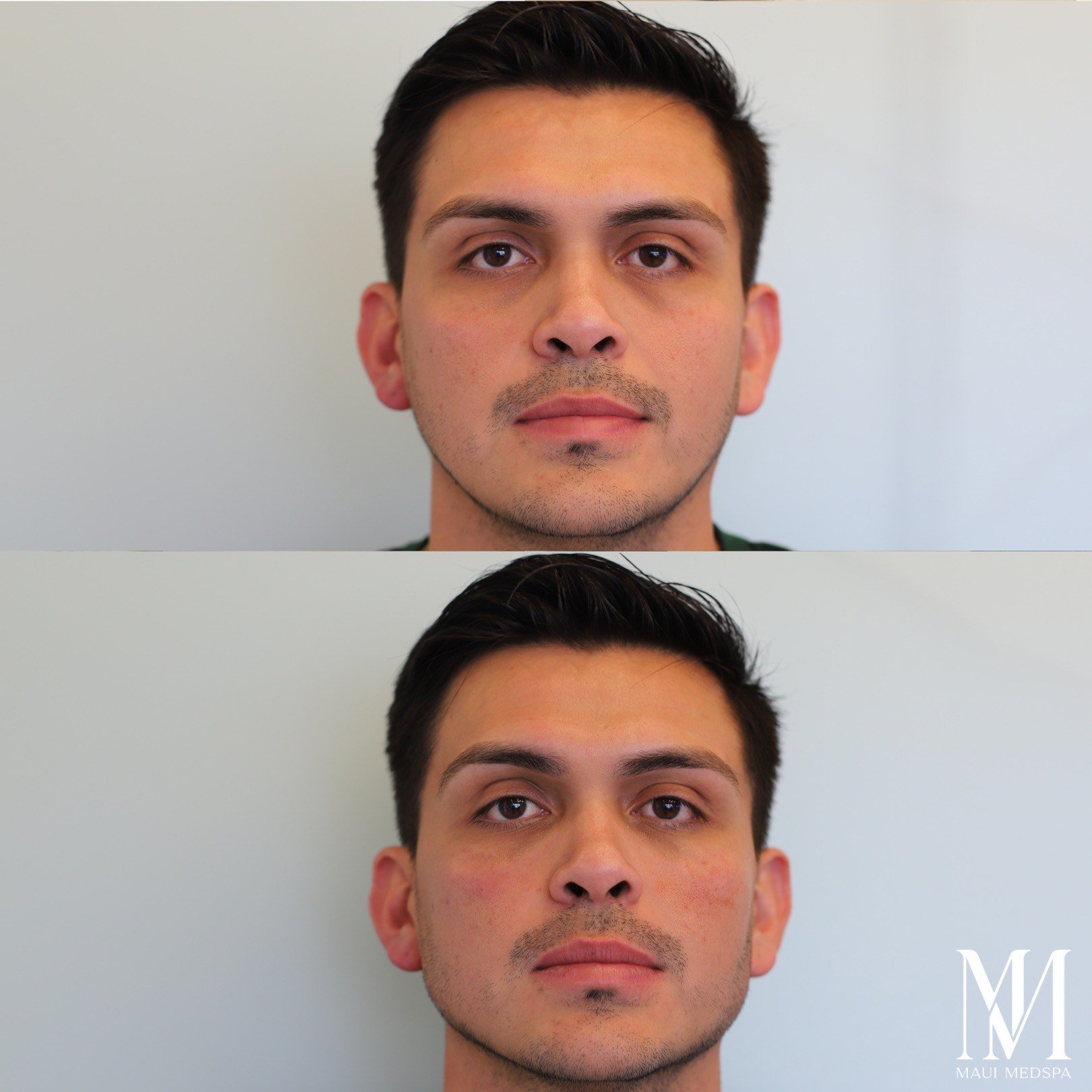 Masculinizing Filler for me, and what does masculinizing filler look like on men.
