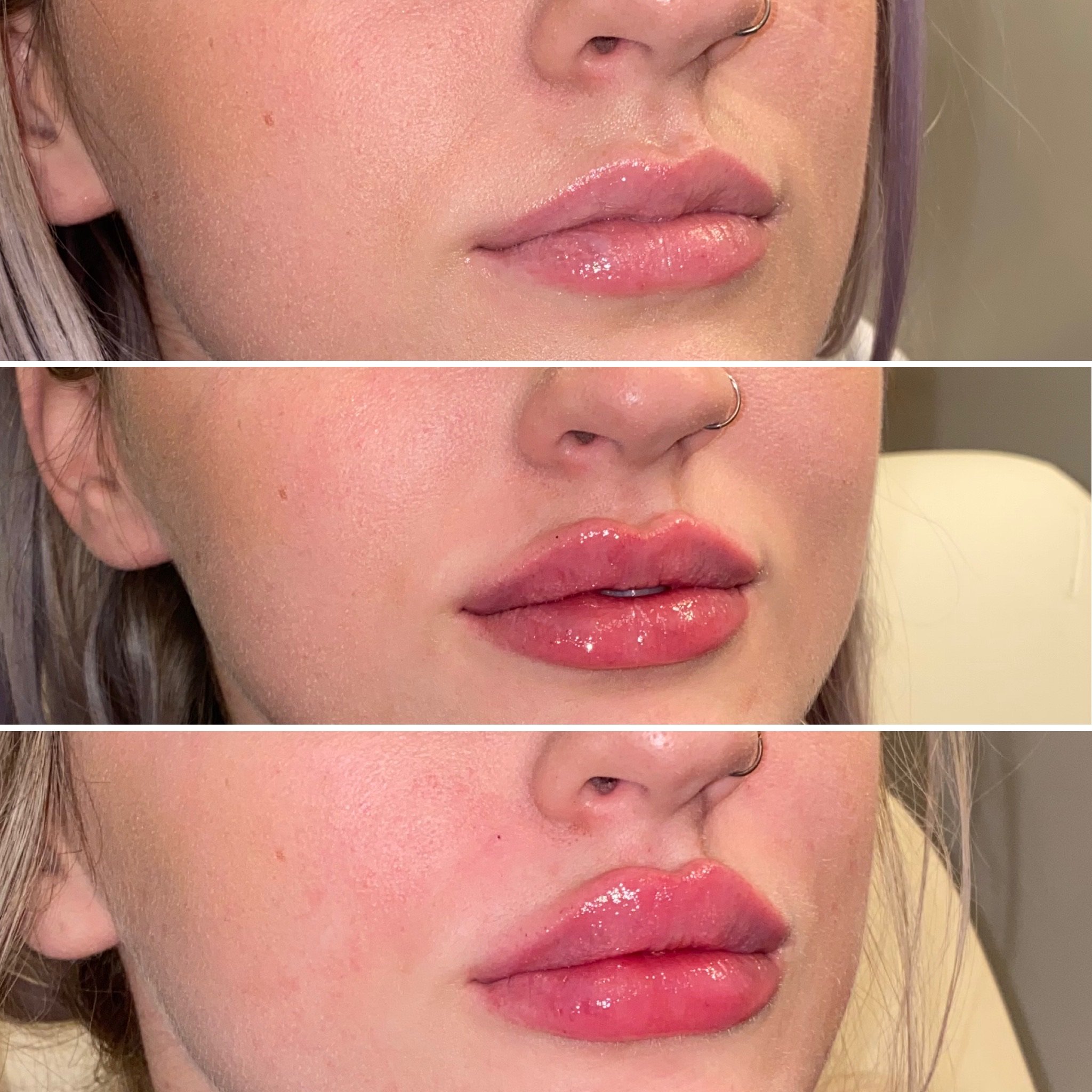 Austin Lip Augmentation - Lip Injections & Implants