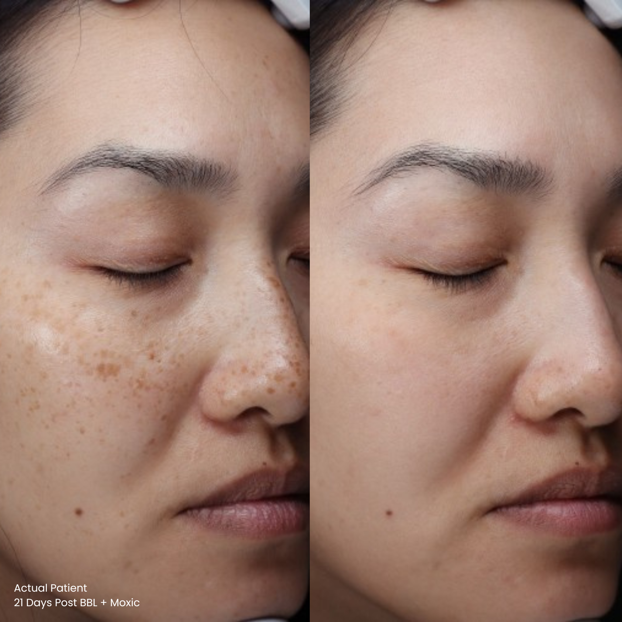 Asian woman BBL + Moxi laser combo results