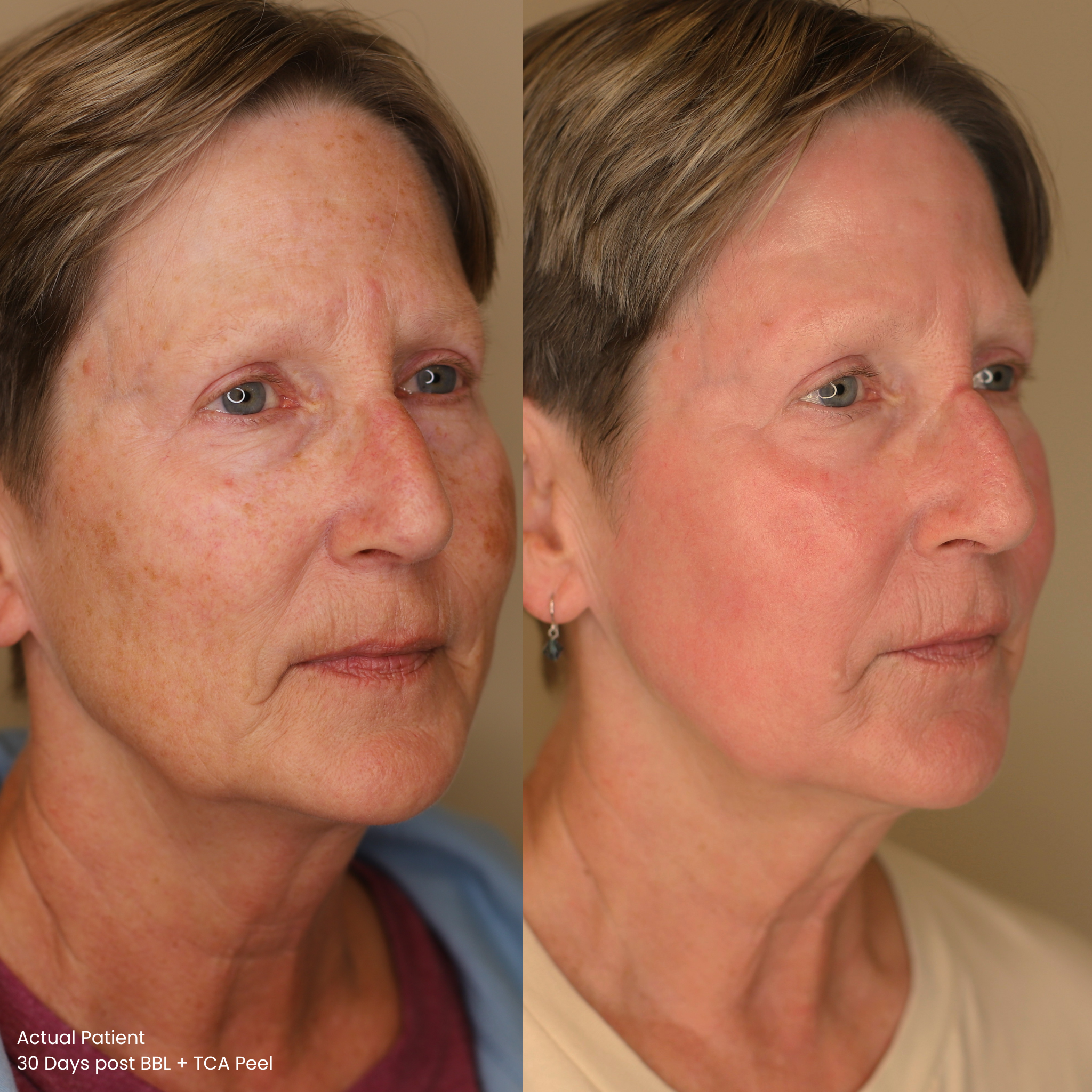 Before and After BBL Photofacial