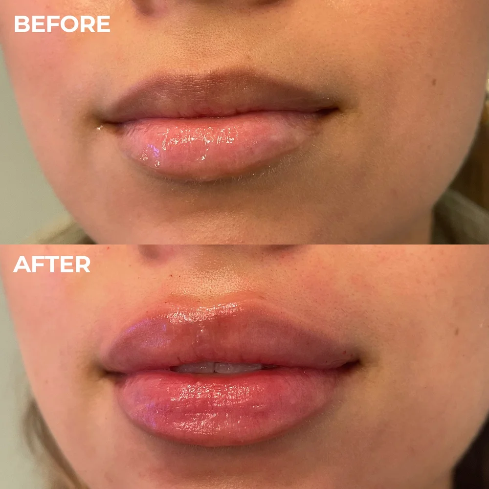 Best Lip Fillers in Austin, TX Lip Augmentation Maui MedSpa