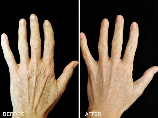 Renuva injections for back of hand before and after