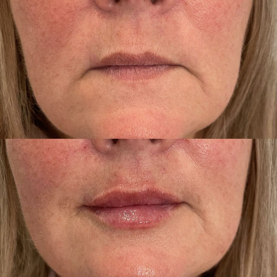 Lip filler before and after image from Maui Medical Spa in Austin Texas. The best place to get lip filler in Austin texas. Lip filler for hydration. Lip filler for mature people