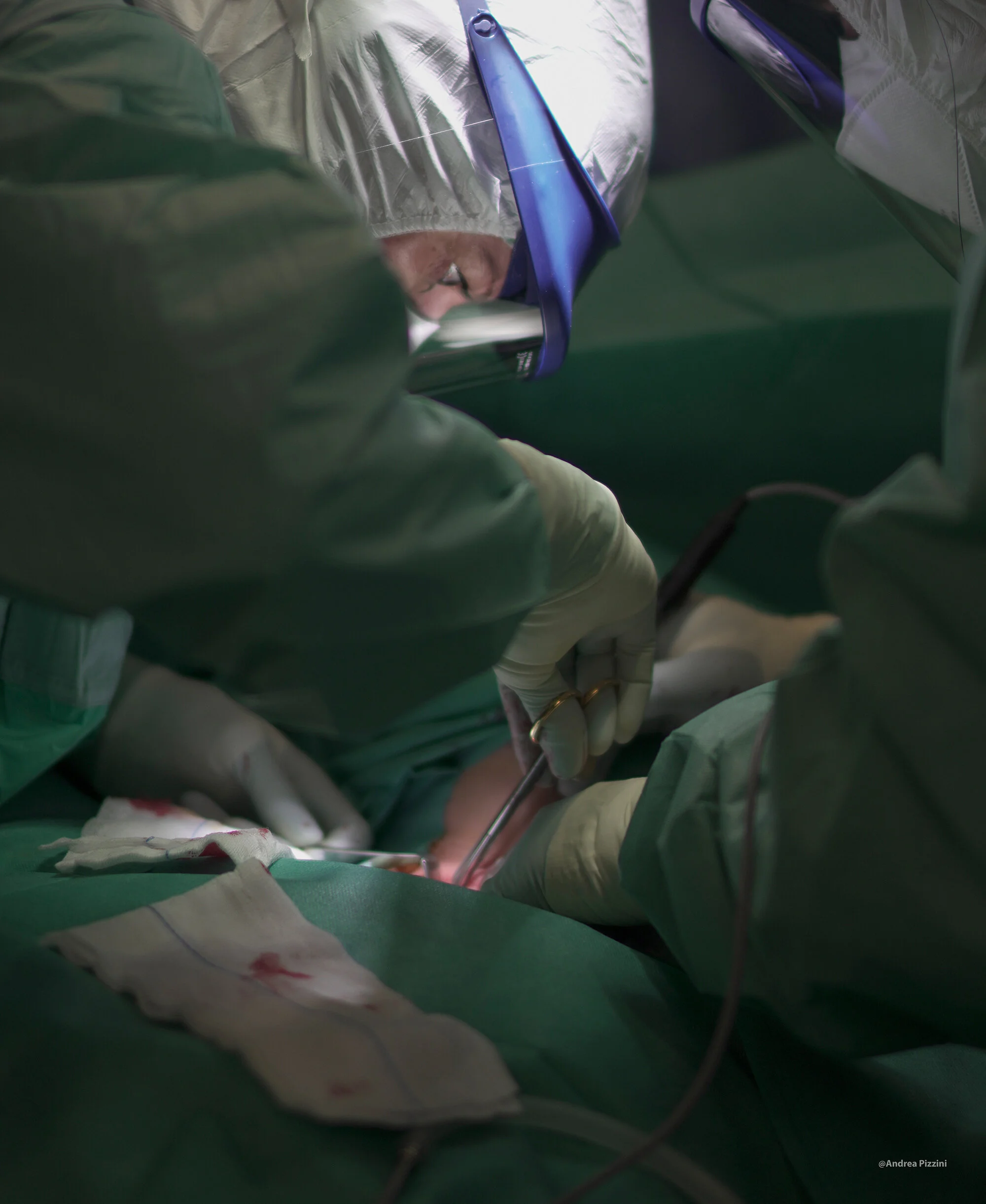 L'occhio di un chirurgo mentre lavora ad una tracheotomia