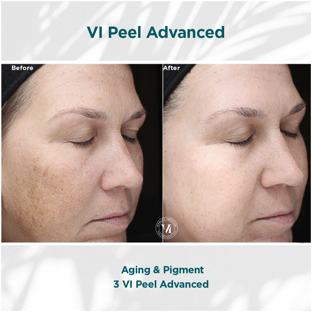 Side-by-side comparison of a woman's face before and after undergoing VI Peel Advanced skin treatment, showing reduced pigmentation and signs of aging.