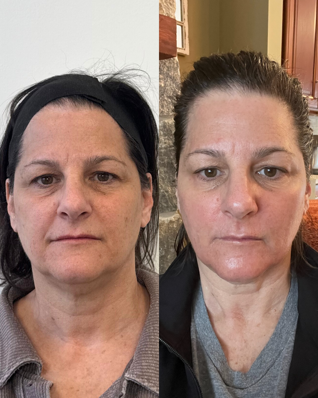 co2 skin resurfacing