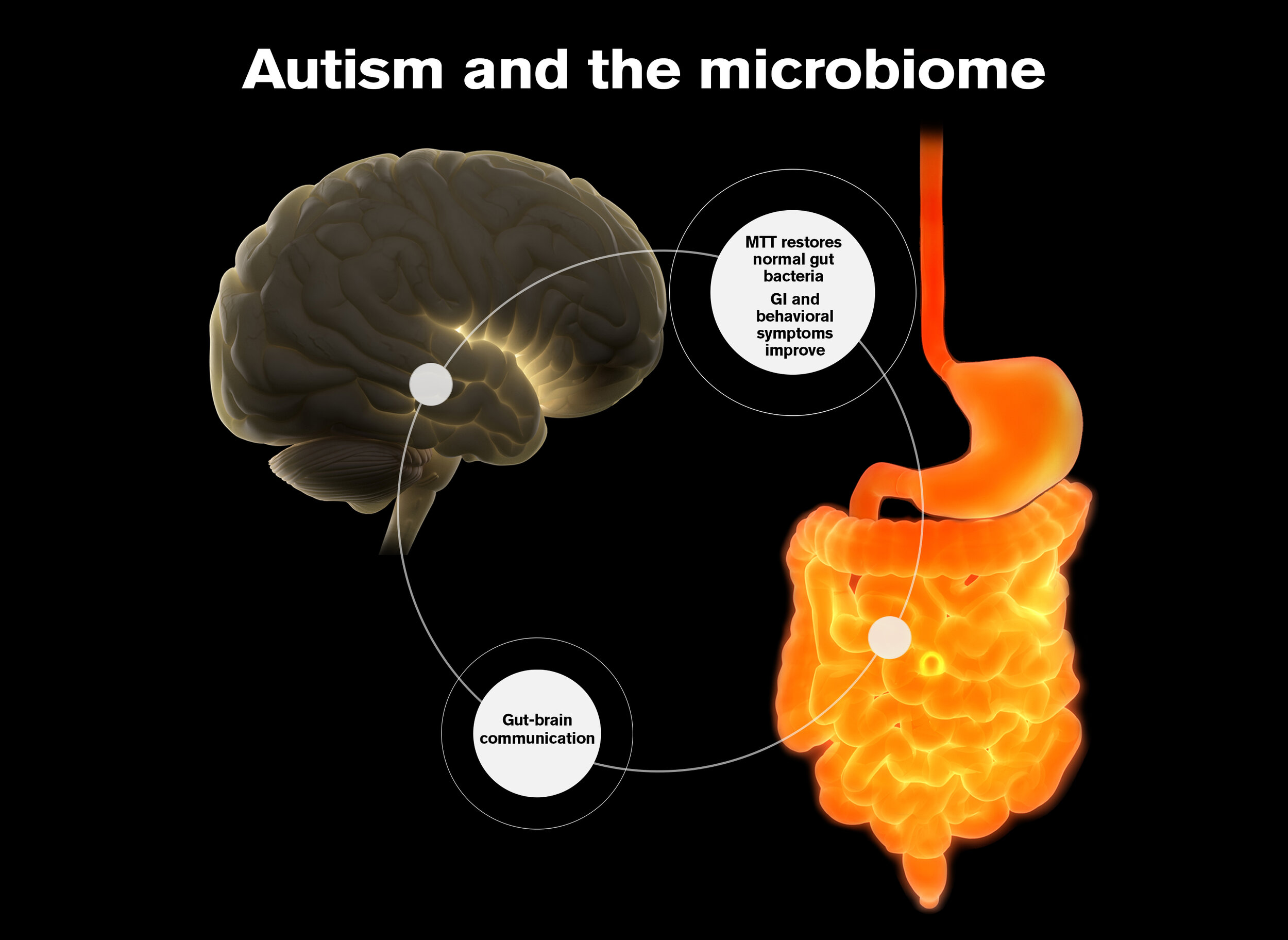 Autism Symptoms reduced after Fecal Transplant by Dianne Price