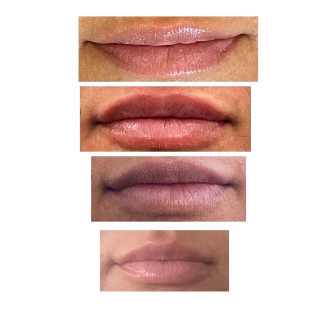 💋Lips are a process💋 

I believe in starting slow and getting to your goal lips over the course of a few weeks. This allows us to see how the filler will settle and what areas need touching up to get to the perfect, natural pout 👄

First pic: Befo