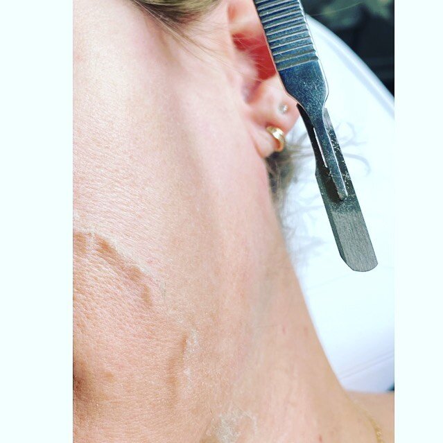 Here&rsquo;s an example of what comes off your face when we dermaplane! 

Dermaplanjng is a manual exfoliation technique that gets rid of the top layer of dead skin and hair allowing for better absorption of skin care products and flawless makeup app