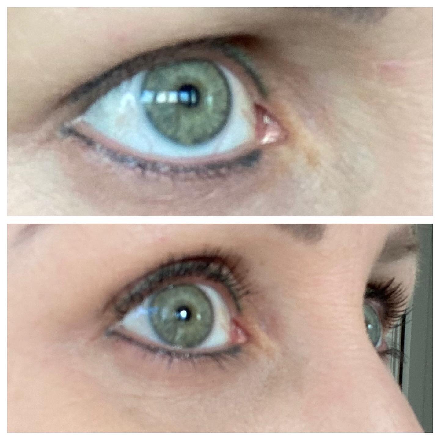 3 weeks into using Latisse and already a huge difference 🙌🏻

This before picture was taken after lash extensions were removed and I was left with little to no lashes. 

I&rsquo;ve been applying once a day to top and bottom lash line right before be