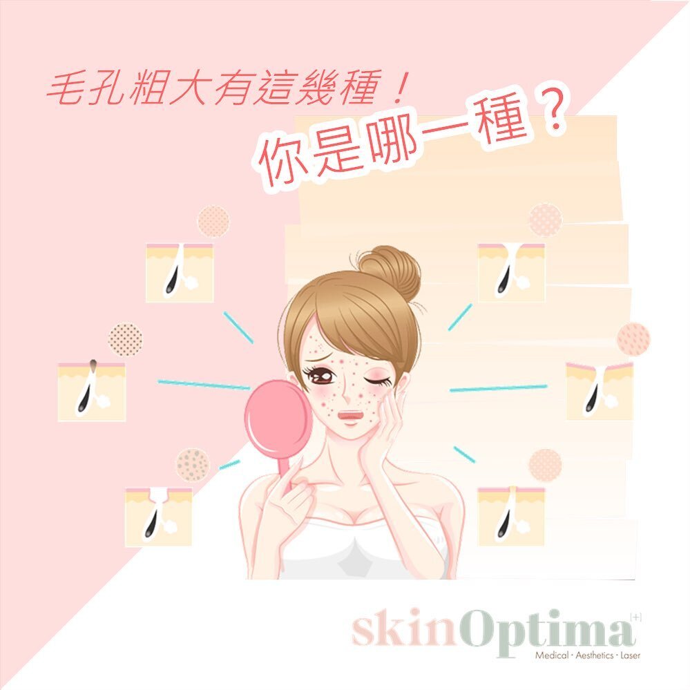毛孔粗大有這幾種！你是哪一種？

【出油型毛孔粗大】

特徵：
毛孔呈現U型擴大，主要出現在兩頰部位與T字部位

形成原因：
出油的膚質，導致毛孔粗大，要特別留意的是不管太乾或太油的肌膚都有可能有出油問題。

改善毛孔粗大保養法：
除了調整作息與飲食，少熬夜睡眠充足，少吃油炸食物和甜食甜飲，如果要改善出油膚質，還是要找專業皮膚科醫師評估與治療。

【老化型毛孔粗大】

特徵：
毛孔形狀如同水滴狀

形成原因：
毛孔周邊組織膠原蛋白流失、肌膚老化。

改善毛孔粗大保養法：
在老化型的毛孔粗大方面更