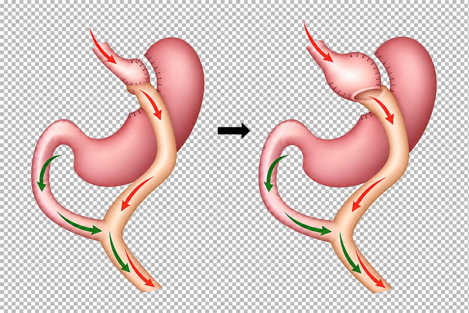 Verwijde maagpouch na een gastric bypass (Roux-en-Y)