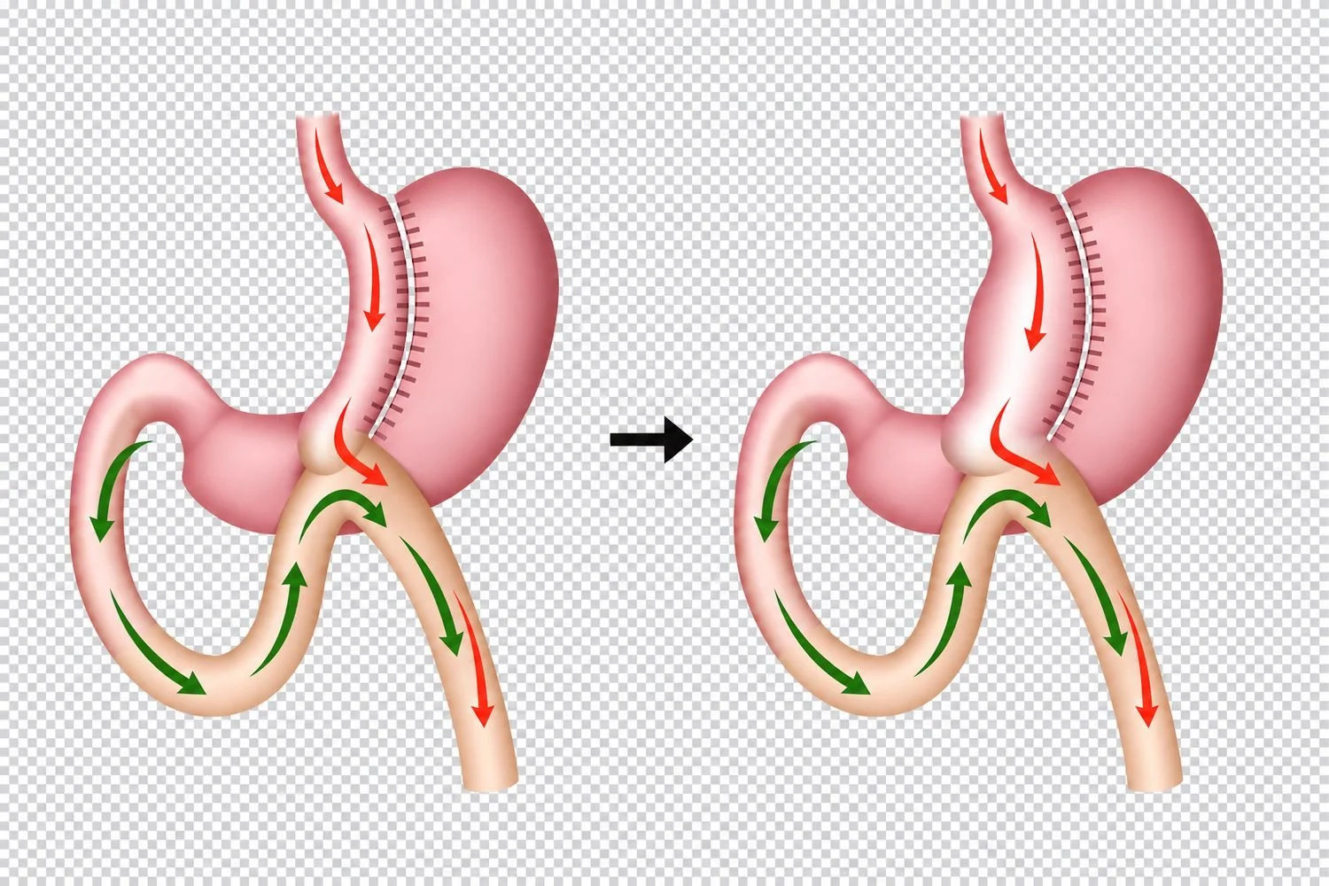 Verwijde maagpouch na een omega- of mini-gastric bypass (OAGB)