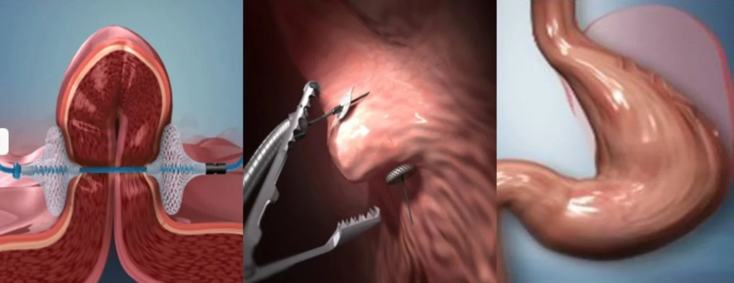 Illustratie van de POSE-procedure: de maagwand wordt endoscopisch geplooid en verankerd