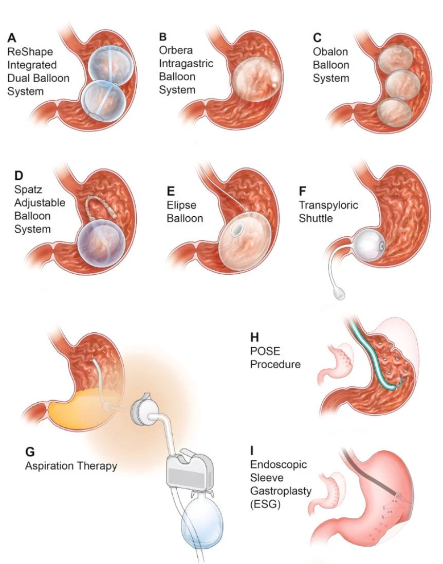 Overzicht van endoscopische behandelingen: verschillende maagballonnen, aspiratietherapie, de POSE-procedure en endoscopische sleeve gastroplastie