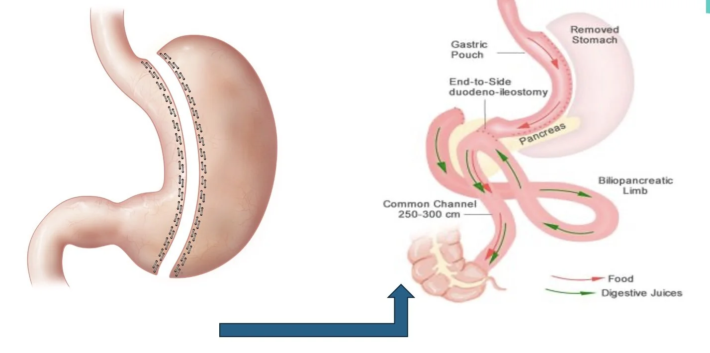 Conversie van een gastric sleeve naar een SADI-S