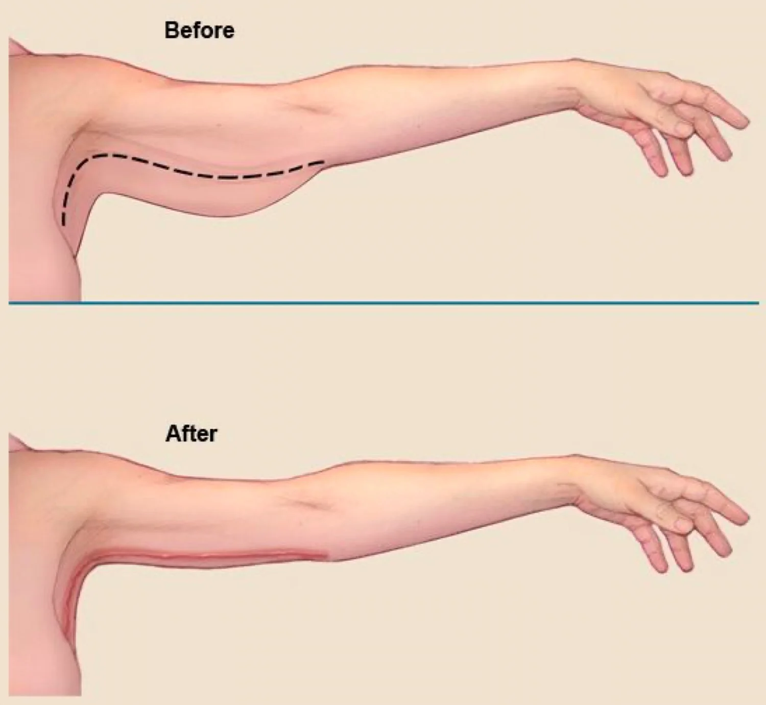 Illustratie van een bovenarmcorrectie: de arm voor en na het wegnemen van het huidoverschot