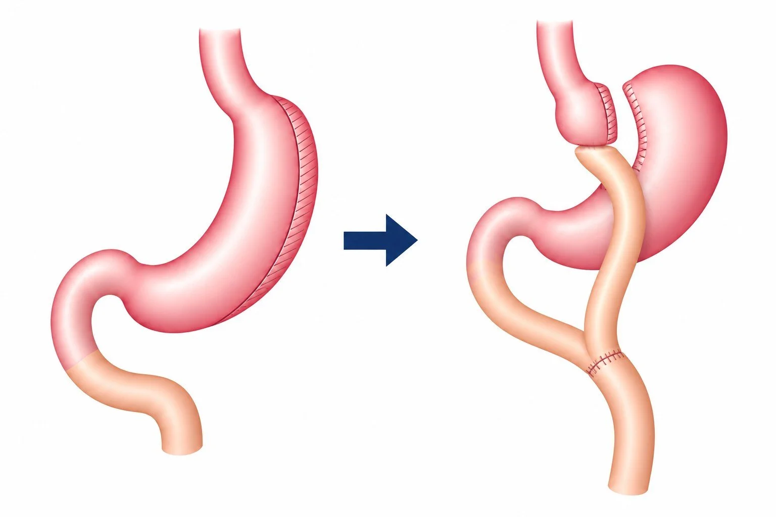 Conversie van een gastric sleeve naar een gastric bypass