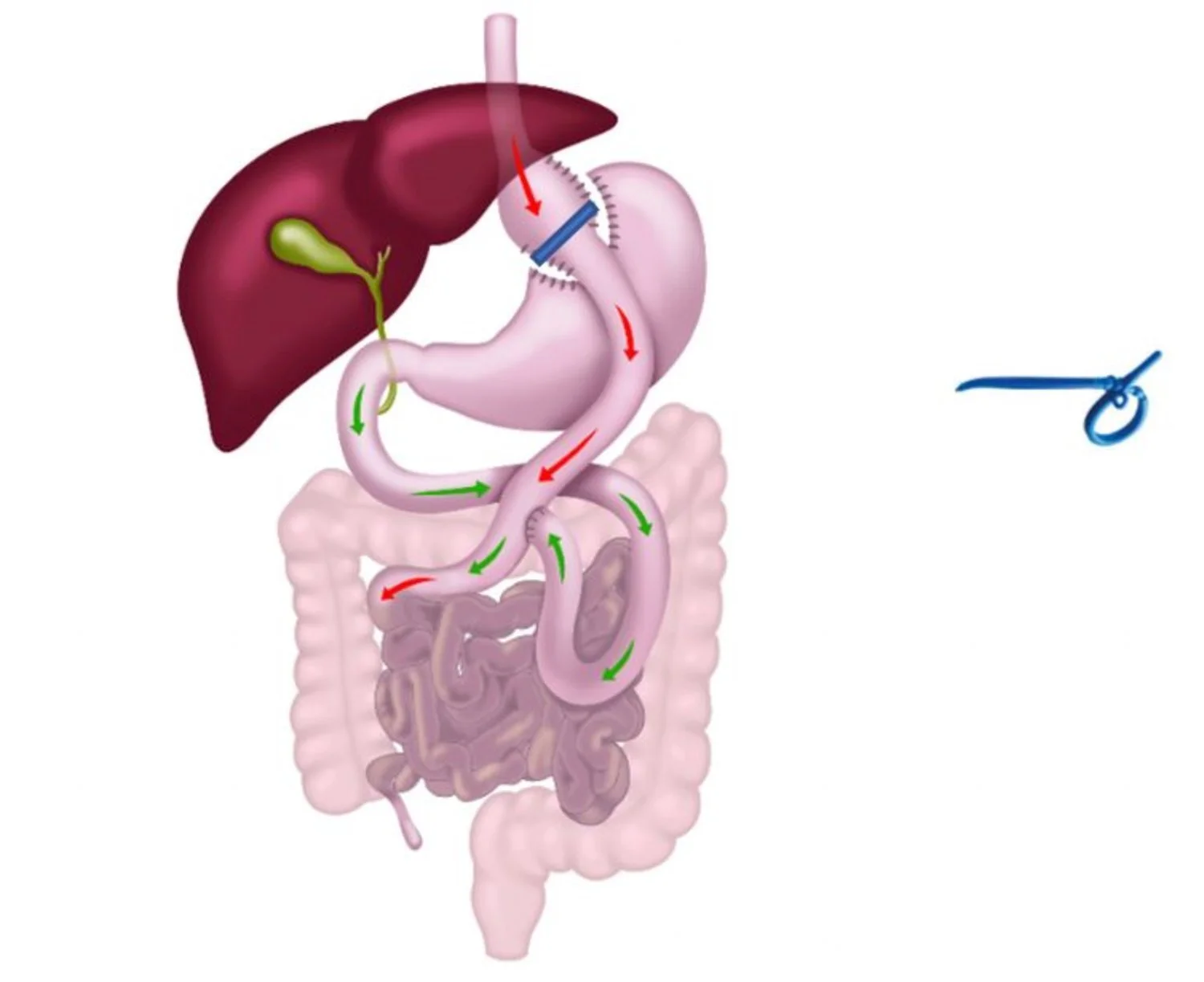 Anatomische illustratie van een banded procedure, met de siliconenring rond het bovenste deel van de maag