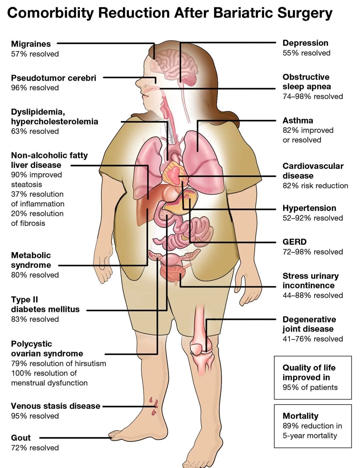 Infographic: afname van comorbiditeiten na bariatrische chirurgie, waaronder diabetes type 2, slaapapneu, hypertensie en reflux